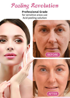 30 ml surowicy do peelingu skóry / profesjonalnego zestawu płynów do rozwiązania do łuszczenia skóry twarzy
