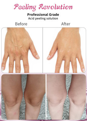 Profesjonalny roztwór do peelingu kwasem