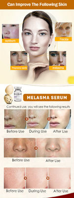 Pielęgnacja skóry Meso Serum do usuwania mikronakłuć Serum do piegów Melasma Wybielanie skóry